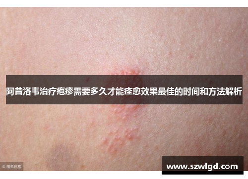 阿昔洛韦治疗疱疹需要多久才能痊愈效果最佳的时间和方法解析
